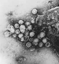 Cúmulo del virus varicela-zoster en una muestra de líquido cefalorraquídeo de un enfermo de esclerosis múltiple