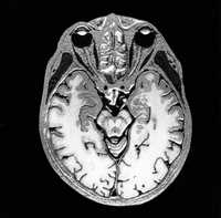 Un escaneo muestra los hemisferios cerebrales. El estudio de la Universidad de Wisconsin-Madison no aclara porque el compuesto IKKbeta/NK-kappaB está en el cerebro y en el sistema inmune