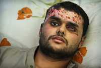 Mohammed Haddad, herido durante la ofensiva militar israelí, yace en un hospital de la ciudad de Gaza gravemente quemado con fósforo blanco, prohibido por todas las convenciones internacionales sobre armamento